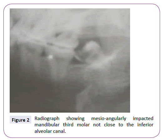 neurology-neuroscience-mesio-angularly