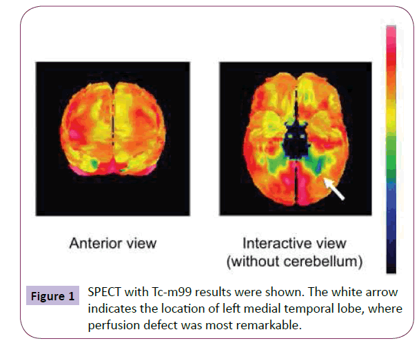 neurology-neuroscience-perfusion-defect