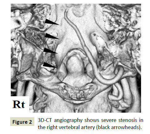 neurology-neuroscience-severe-stenosis