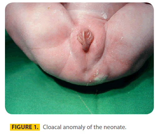 transbiomedicine-Cloacal-anomaly