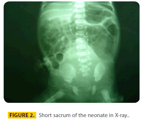 transbiomedicine-Short-sacrum