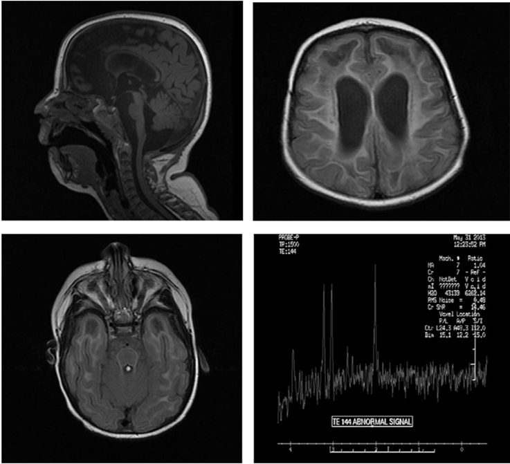 transbiomedicine-microcephaly-moderate-ventriculomegaly