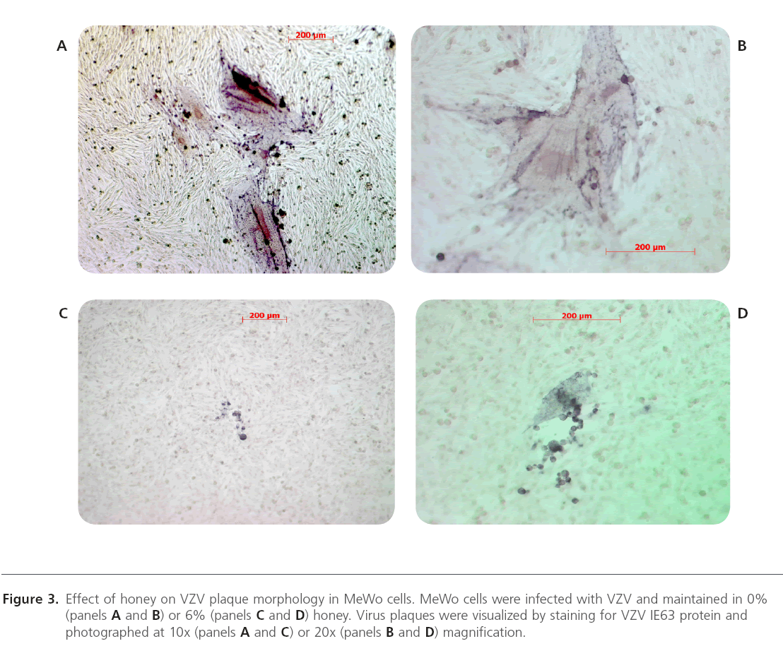 translational-biomedicine-VZV-plaque